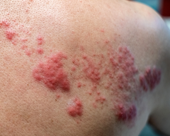 There-is-a-shingles-vaccine-available-in-Norbury-for-shingles-symptoms-on-the-back.